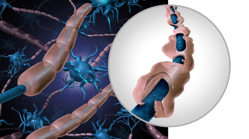 Spina bifida nedir? Tedavi ve türleri nelerdir?