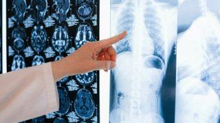 Akalazya hastalığı nasıl bir hastalıktır? Belirtileri nelerdir?