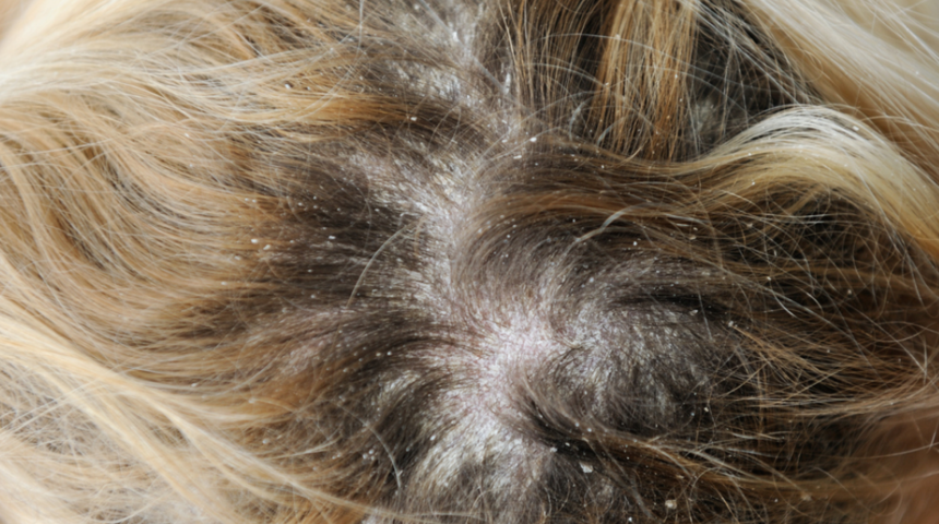 'Kepek nasıl geçer?' sorusuna gerçekçi çözümler bulduk! Şampuanın miktarı bile...