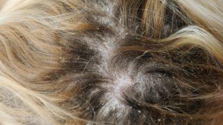 'Kepek nasıl geçer?' sorusuna gerçekçi çözümler bulduk! Şampuanın miktarı bile...