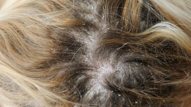 'Kepek nasıl geçer?' sorusuna gerçekçi çözümler bulduk! Şampuanın miktarı bile...