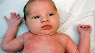 Çocuklarda Yaz Hastalıkları!