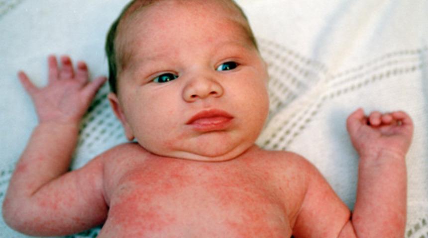 &Ccedil;ocuklarda Yaz Hastalıkları!