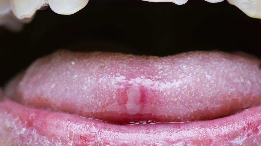 Ağız ülseri ne demektir?