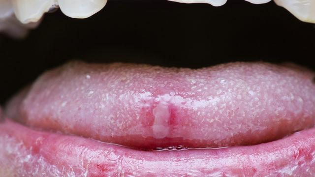 Ağız ülseri ne demektir?