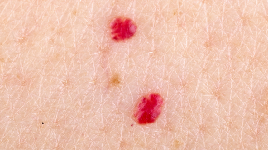 Hastalık habercisi mi? Kırmızı ben neden &ccedil;ıkar, nasıl ge&ccedil;er? 