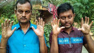 Bangladeş’te parmak izi olmayan aile görenleri şaşkına çevirdi  