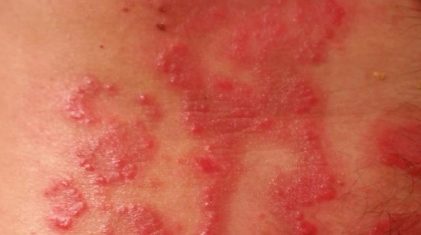 Seboreik dermatit nedir ve nasıl tedavi edilir? 