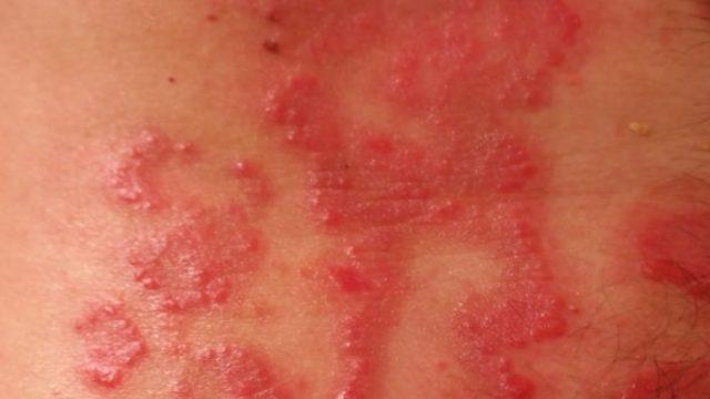 Seboreik dermatit nedir ve nasıl tedavi edilir? 