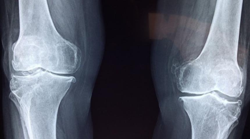 Sinovit rahatsızlığı kimlerde görülür? Sinovit belirtileri ve tedavileri nelerdir?