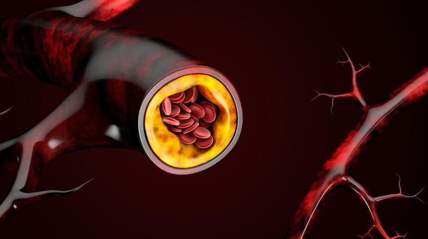 Vldl kolesterol nedir? Vldl kolesterol seviyesi kaç olmalı? 