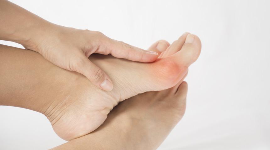 &Ccedil;ağın ortopedik hastalığı: Hallux Valgus