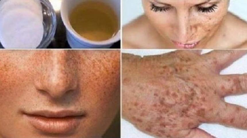 Bu doğal y&ouml;ntemle cildinizdeki lekelerden sadece birka&ccedil; haftada kurtulabilirsiniz!