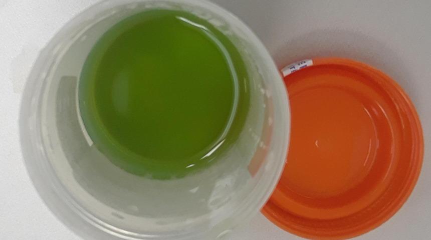 İlginç olay: 62 yaşındaki adamın idrarı yeşile döndü!