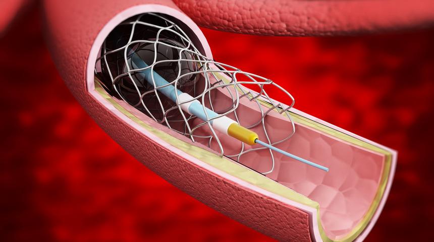 Stent uygulaması hakkında tüm merak edilenler