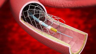 Stent uygulaması hakkında tüm merak edilenler