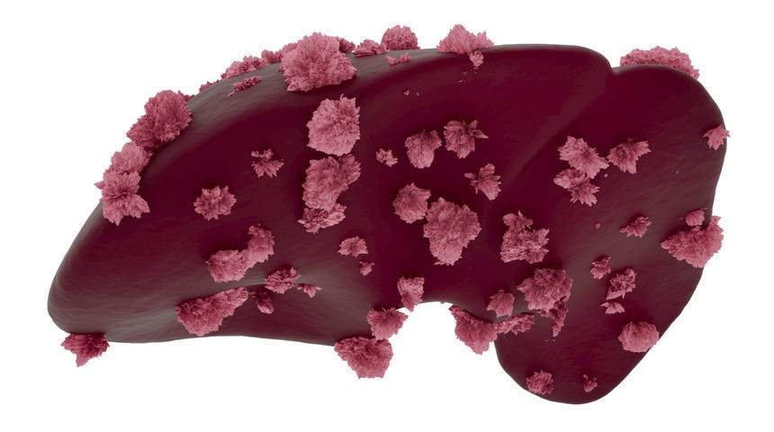 Karaciğer metastazı nasıl bir hastalıktır ve belirtileri nelerdir?