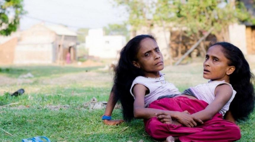 İlk g&ouml;r&uuml;şte aşk ger&ccedil;ekmiş: Yapışık ikizler aynı adama aşık oldu!