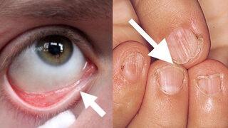 Demir eksikliğinin en önemli işaretleri ve kanınızdaki demir oranını artırmanın yolu