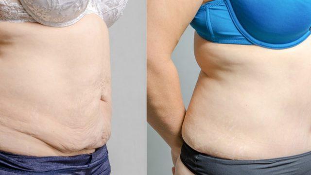 Karın germe ameliyatı öncesi ve sonrasında bunlara dikkat!