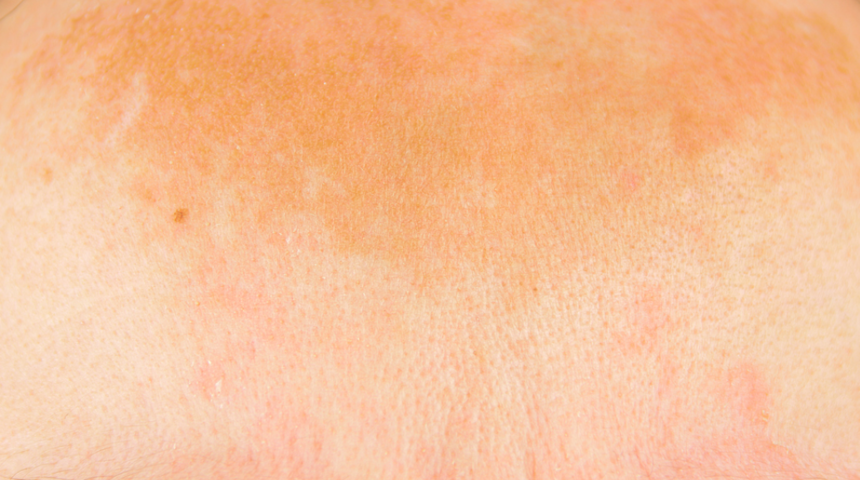 En sık alın ve &uuml;st dudakta g&ouml;r&uuml;l&uuml;yor! Hamilelikte cilt lekelenmesi nasıl ge&ccedil;er?