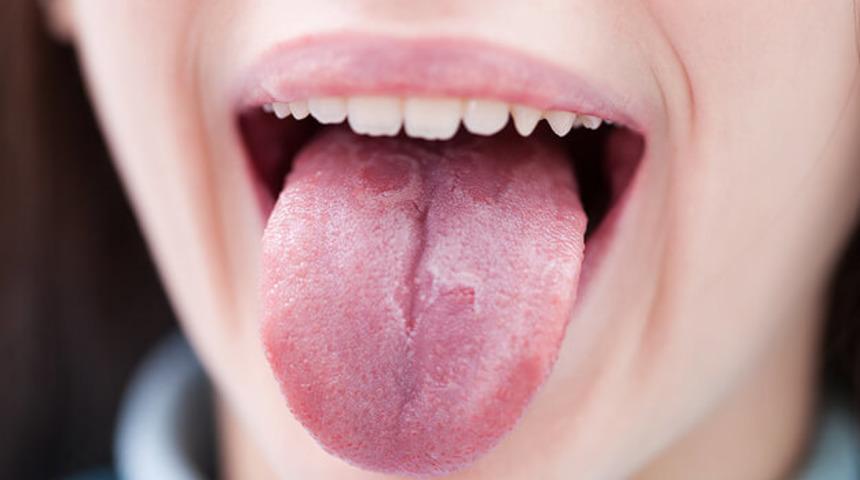 Dil yanmasını bu kolay y&ouml;ntemle saniyeler i&ccedil;inde iyileştirin!