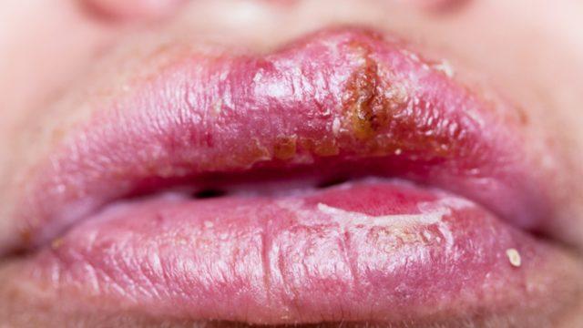 Uçuk neden çıkar, bulaşıcı mıdır? Dudak uçuğu nasıl belirti gösterir ve nasıl tedavi edilir?