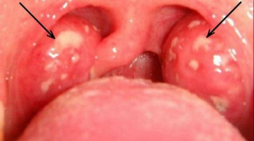 İltihaplı bademcikleri antibiyotik kullanmadan iyileştirmenin en basit yolu! 