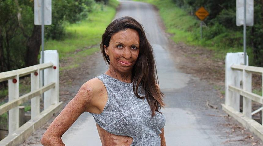 Vücudunun yüzde 65’i yanan Turia Pitt’in ilham veren hikayesi!