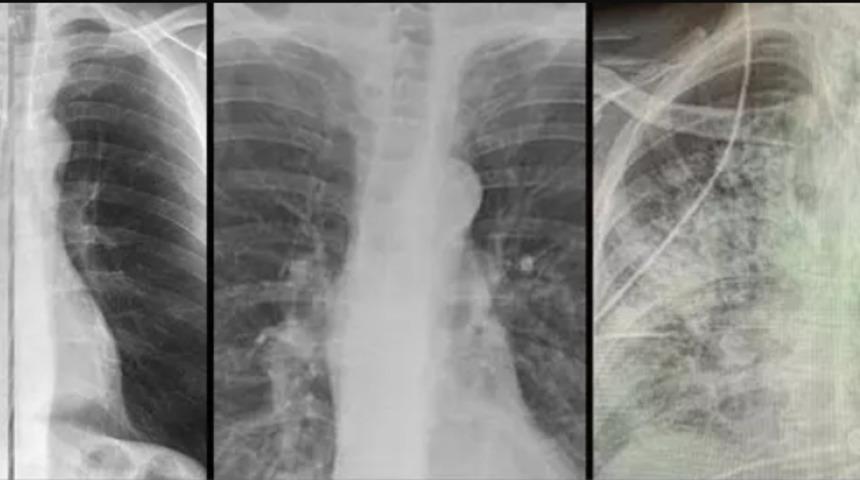 Koronavirüsün korkunç etkisi ortaya çıktı!