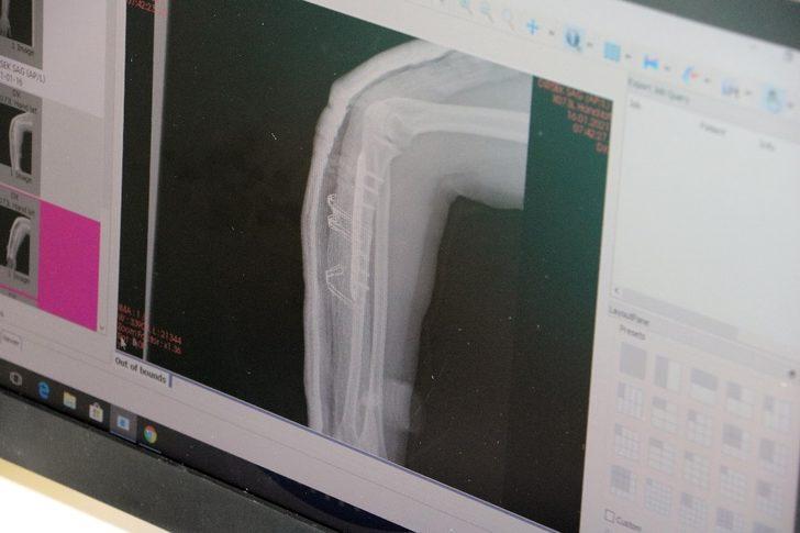 Kar ve buzlanma nedeniyle düşmelere bağlı kırık ve çıkık vakaları arttı G3