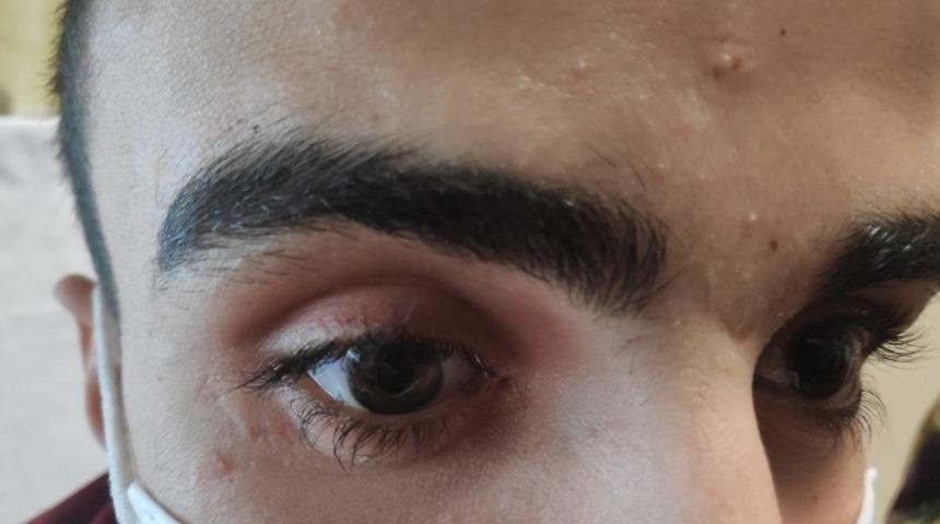 G&ouml;z&uuml;nde unutulan cam kırığı ile bir ay yaşadı