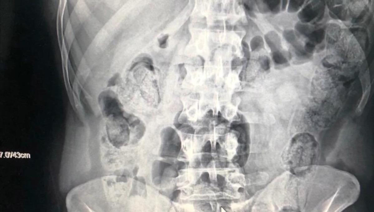 Yolcu kılığındaki kuryelerin midelerinden 871 gram uyuşturucu &ccedil;ıktı