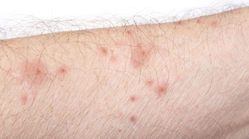 Uyuz hastalığına dikkat! En önemli belirtisi gece artan kaşıntı