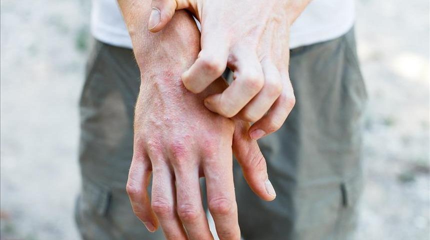 ''Atipik egzama" medeniyet hastalığı oldu