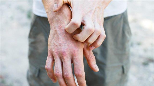 ''Atipik egzama medeniyet hastalığı oldu