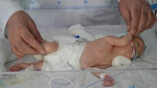 Kilosu kadar tümörle dünyaya gelen bebeğe ameliyat