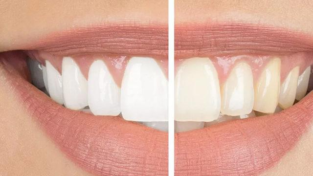 Uzmanı uyardı! Daha beyaz bir gülüşe sahip olma hayali kabusunuz olmasın
