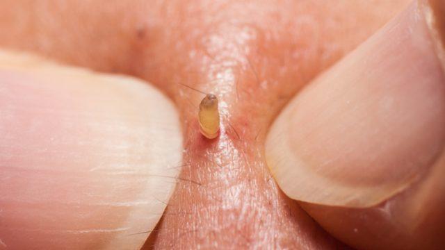 Sıkmak çözüm değil... Akneleri yok eden doğal yöntemle tanışın! Sirke ve aloe vera...