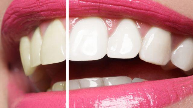 Dişlerini beyazlatmak isteyenler dikkat! Ev tipi diş beyazlatma yaptırırken...