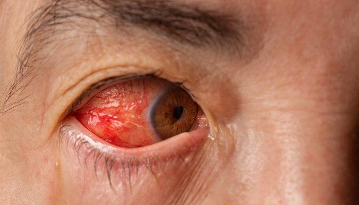 Göz alerjisine ne iyi gelir? Göz alerjisi nedenleri arasında evinizdeki