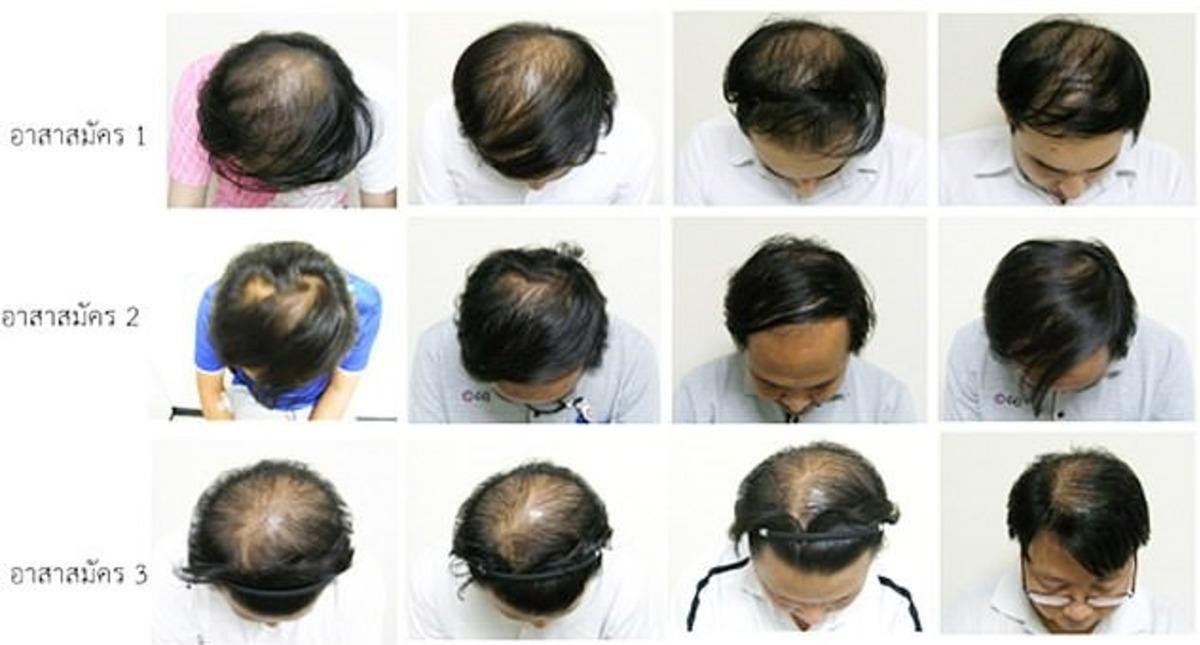 Taylandlı bilim insanları kelliğe &ccedil;are olabilecek bir &ouml;z keşfetti