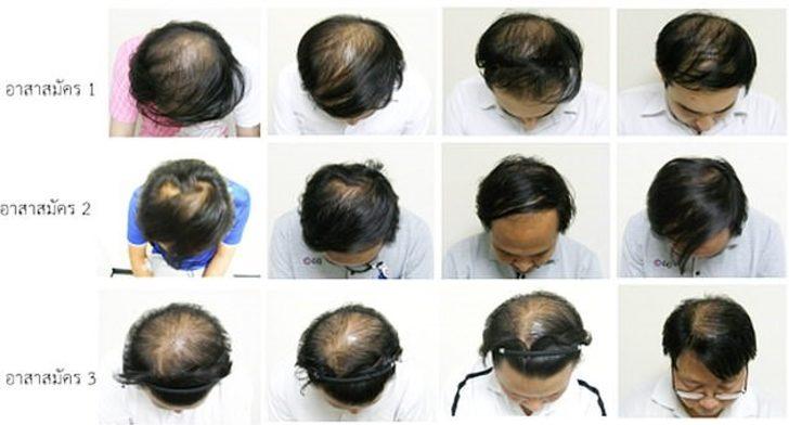 Taylandlı bilim insanları kelliğe çare olabilecek bir öz keşfetti G1