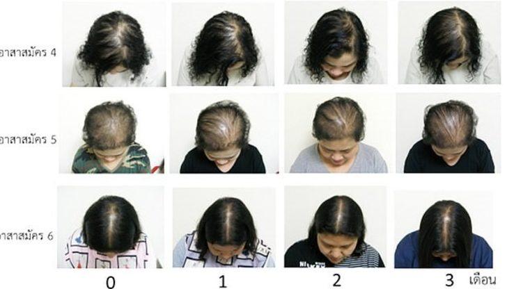 Taylandlı bilim insanları kelliğe çare olabilecek bir öz keşfetti G2