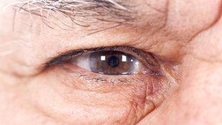 Katarakt nedir, neden olur? Bu belirtilerle başlıyor!