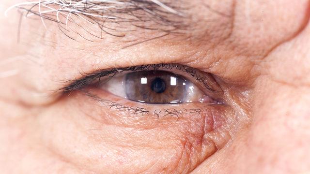 Katarakt nedir, neden olur? Bu belirtilerle başlıyor!