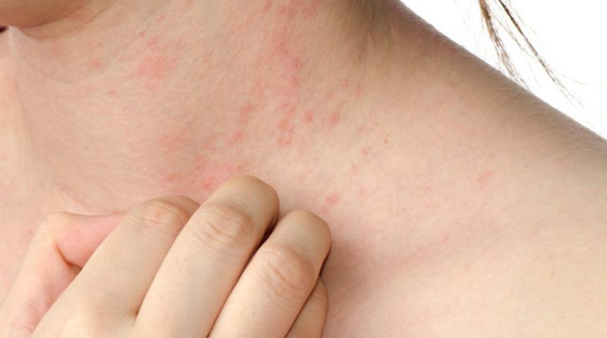 Dikkat! Gıda alerjileri son 10 yılda 2 kat attı