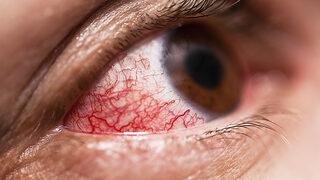 Göz kanlanması neden olur? Nasıl geçer?