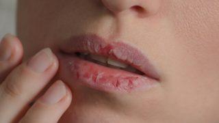 Dudak çatlamasına ne iyi gelir? Dudak çatlaması evde uygulanabilecek doğal bitkisel yöntemlerle anında iyileşecek!
