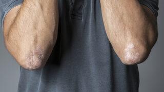 Sedef hastalığı tedavisi mümkün! Sedef hastalığı nasıl geçer?